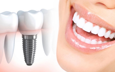 دوره تخصصی دستیارایمپلنت دندانپزشکی